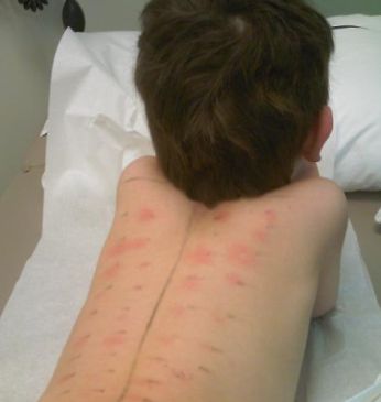 Allergies in Children When to See a Pediatric Allergist